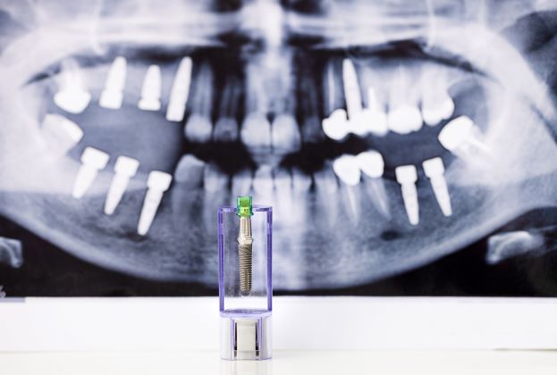 Evening Bites: Endodontic Prognosis in the Implant Era